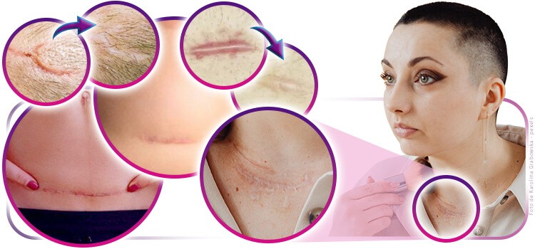 Saiba como orientar o paciente no uso correto de cicatrizantes